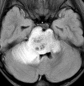 brainstemgliomaic1