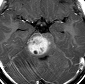 brainstemgliomaic2