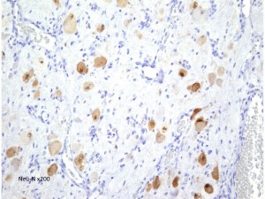 gangliocytoma7