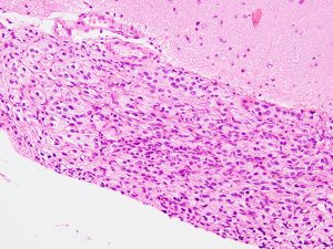 gangliogliomaomsubpia-1