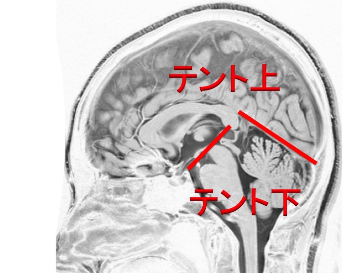 脳腫瘍 上衣腫（じょういしゅ）ependymoma | 脳外科医 澤村豊のブログ
