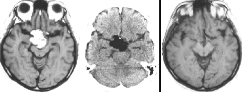 neurohypophyseal mixed germ cell tumorの若年成人男子例2