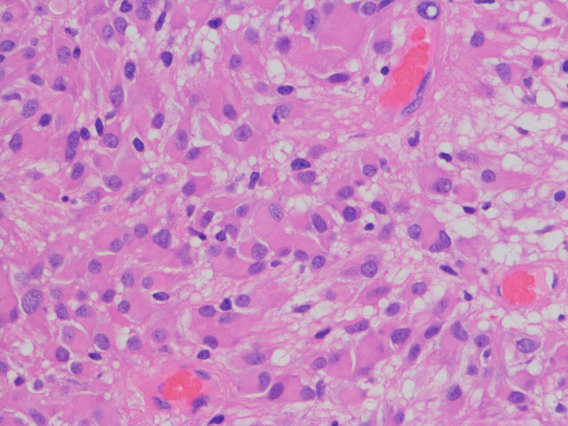 上衣下巨細胞性星細胞腫，結節性硬化症，SEGA | 脳外科医 澤村豊のブログ