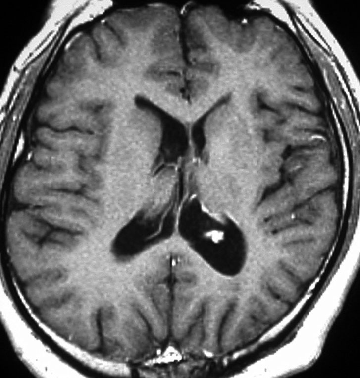 上衣下巨細胞性星細胞腫，結節性硬化症，SEGA | 脳外科医 澤村豊のブログ