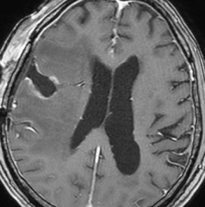 radinecrosis7