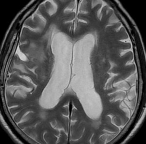 radinecrosis8