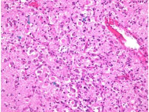 axonalretractionbulb1