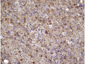 axonalretractionbulb2