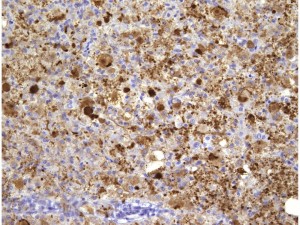 axonalretractionbulb3