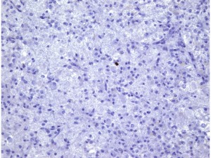 axonalretractionbulb4