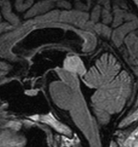tectalglioma4