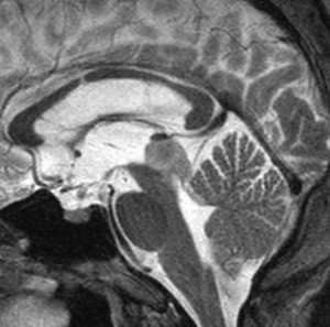 tectalglioma5