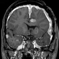 meningiomatosis1
