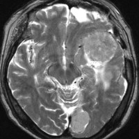 meningiomatosis10