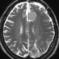 meningiomatosis11