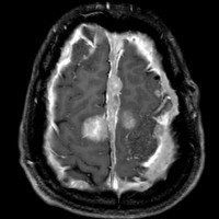 meningiomatosis2