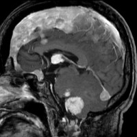 meningiomatosis3