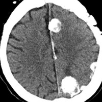 meningiomatosis4