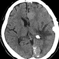 meningiomatosis5