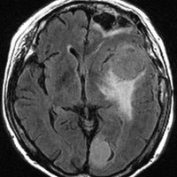 meningiomatosis7