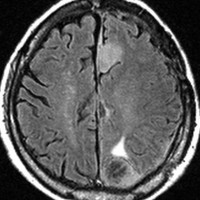 meningiomatosis8