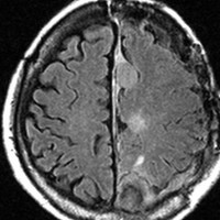 meningiomatosis9