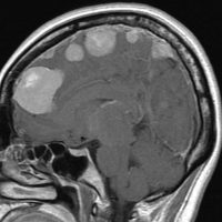 meningiomatosissa2