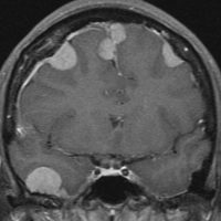 meningiomatosissa3