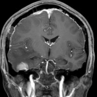 meningiomatosissa4