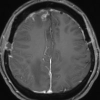 meningiomatosissa5