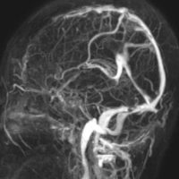 meningiomatosissa6