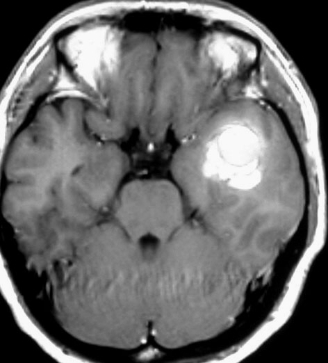 海綿状血管腫 Cavernous Hemangioma Cavernous Malformation 静脈奇形 Venous Malformation 脳外科医 澤村豊のホームページ