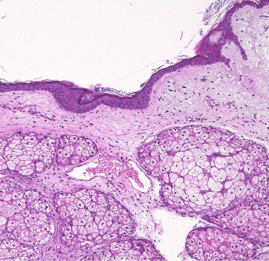 類皮のう胞（類皮嚢胞，類皮腫）dermoid cyst | 脳外科医 澤村豊のホームページ