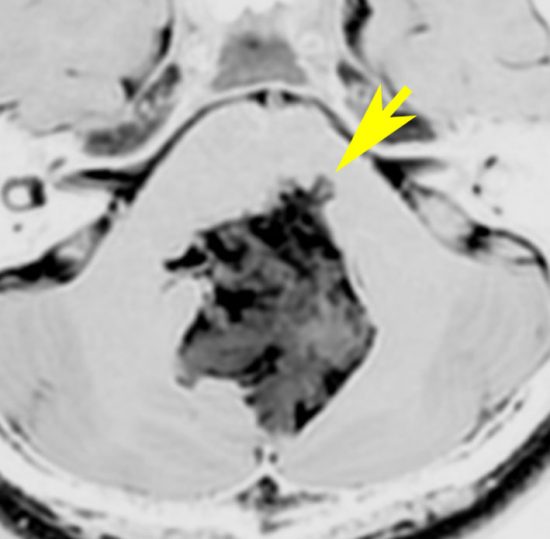 類表皮のう胞 | 脳外科医 澤村豊のホームページ