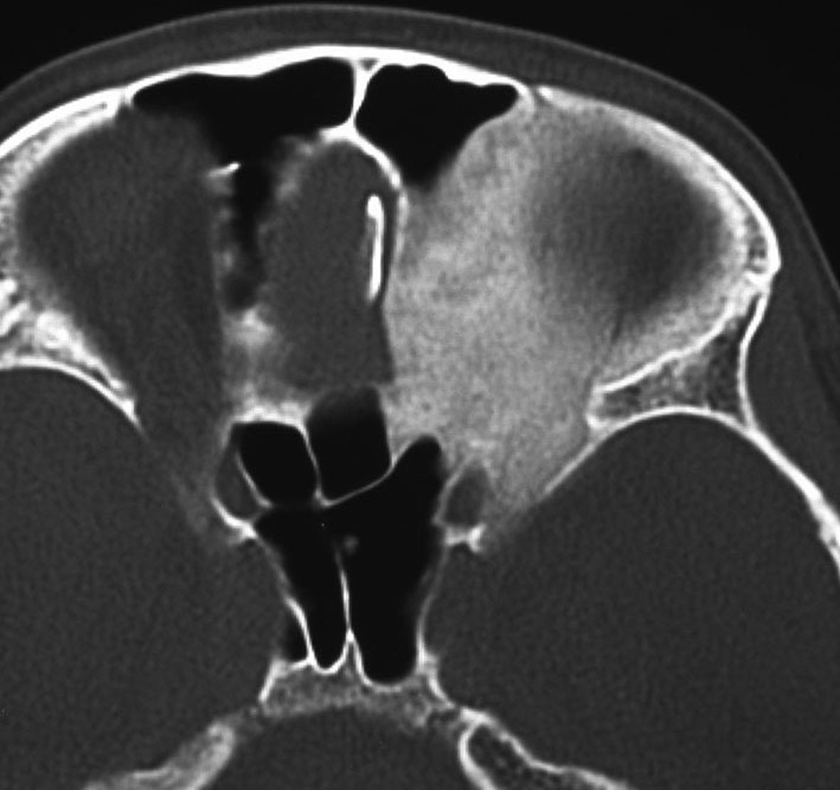 頭蓋骨腫瘍 Skull Tumor 脳外科医 澤村豊のホームページ