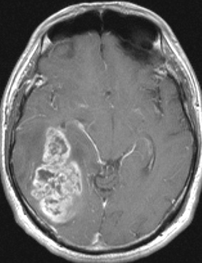 星細胞系腫瘍 Astrocytic Tumor 脳外科医 澤村豊のホームページ