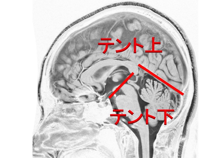 上衣腫（じょういしゅ）ependymoma | 脳外科医 澤村豊のホームページ