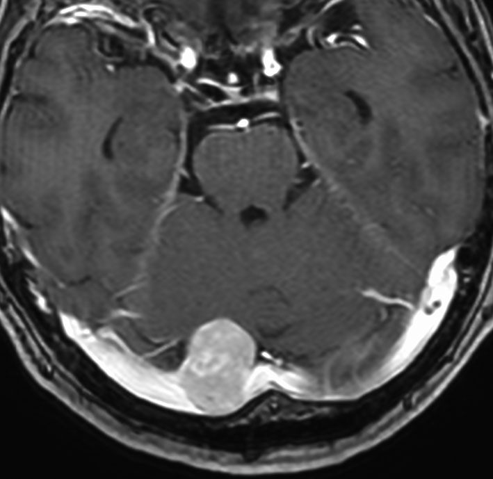 髄膜腫 meningioma | 脳外科医 澤村豊のホームページ