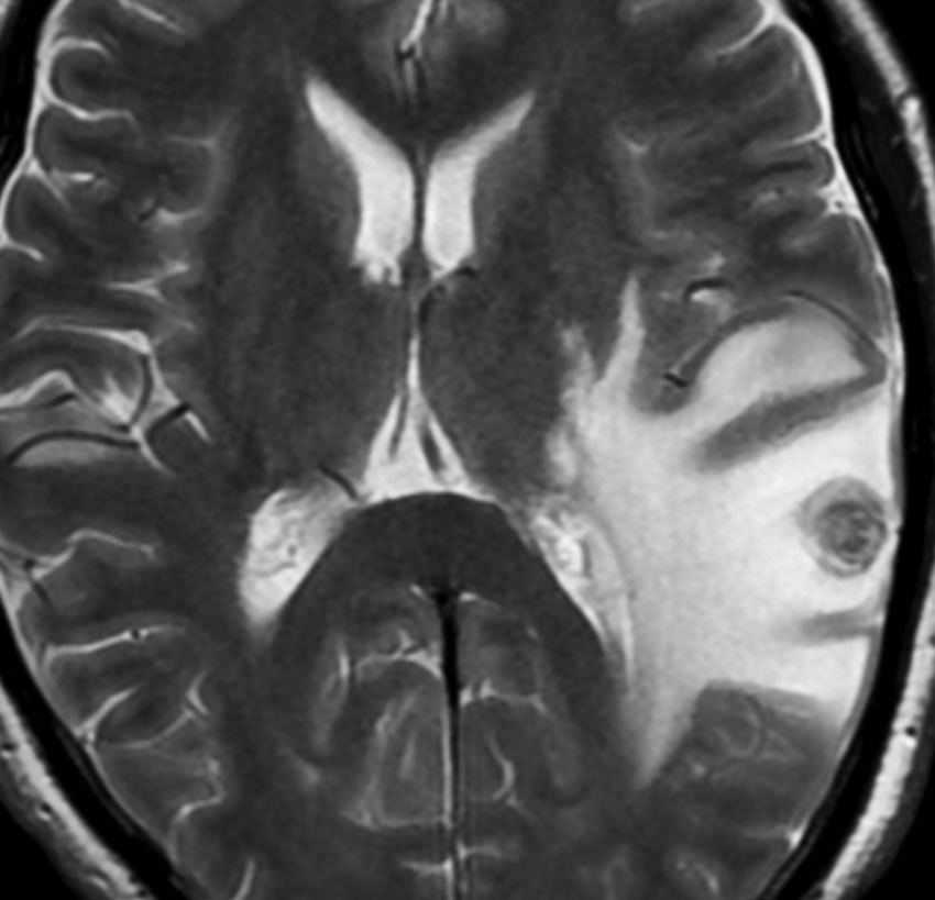 転移性脳腫瘍 Brain Metastasis 脳外科医 澤村豊のホームページ