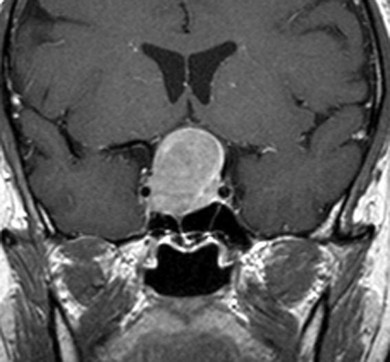 下垂体腺腫 pituitary adenoma（下垂体腫瘍） | 脳外科医 澤村豊の 