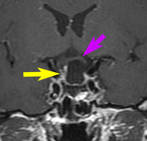 下垂体腺腫 pituitary adenoma（下垂体腫瘍） | 脳外科医 澤村豊の 