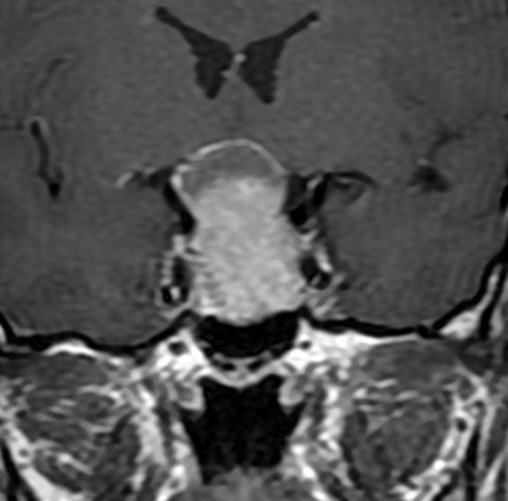 下垂体腺腫 Pituitary Adenoma 下垂体腫瘍 脳外科医 澤村豊のホームページ