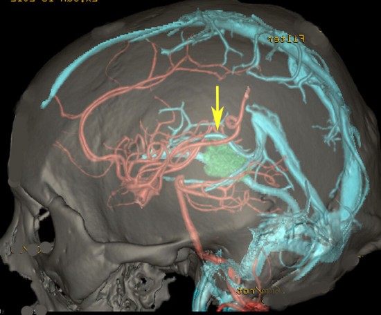 松果体腫瘍 pineal tumor | 脳外科医 澤村豊のホームページ