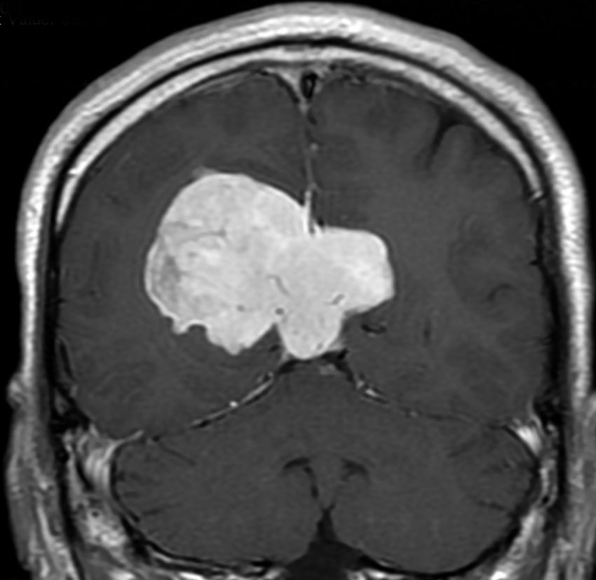 髄膜腫 meningioma | 脳外科医 澤村豊のホームページ
