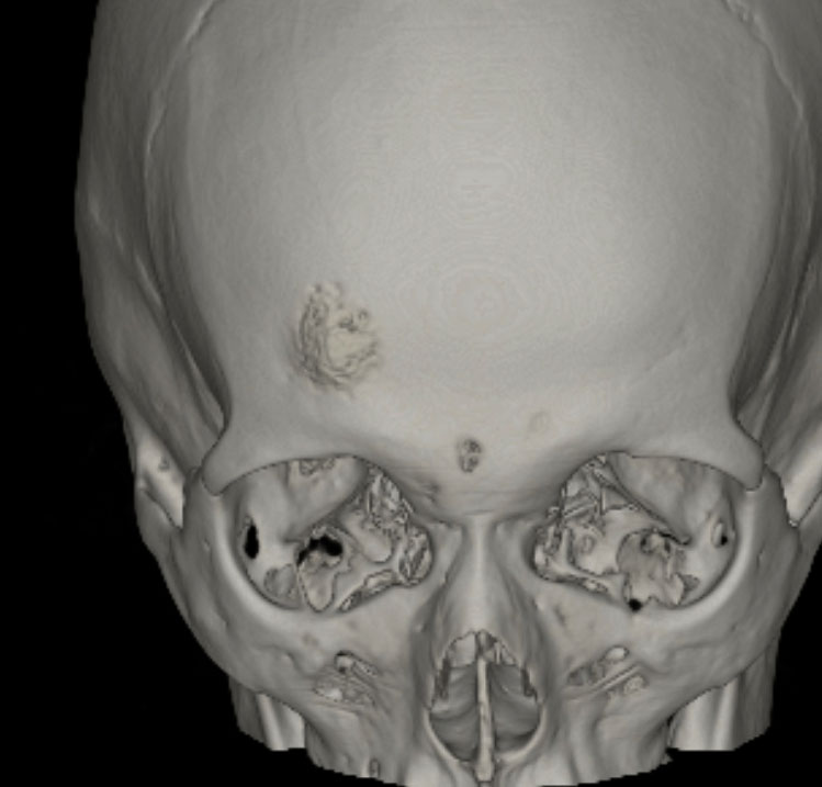 頭蓋骨腫瘍 Skull Tumor 脳外科医 澤村豊のホームページ