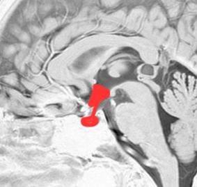 下垂体腺腫 pituitary adenoma, PitNET（下垂体腫瘍） | 脳外科医 澤村 