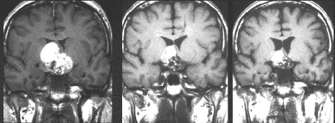 松果体部と視床下部に発生したmixed germ cell tumorの増強MRI