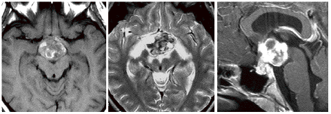 視床下部に発生したchoriocarcinomaのMRI像