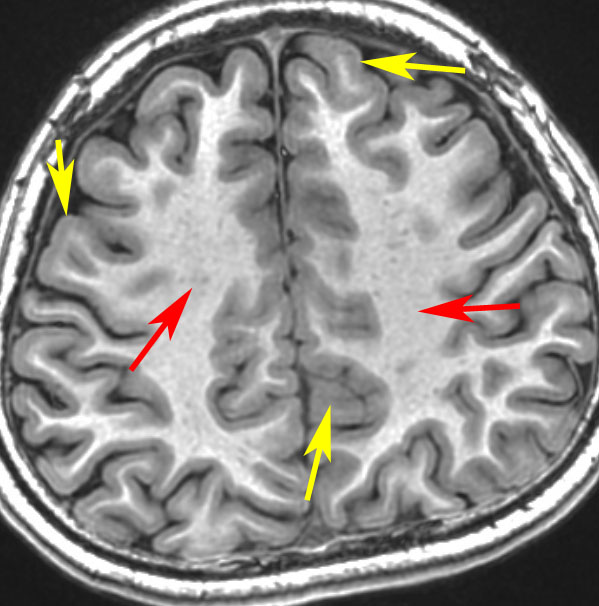 白質と灰白質，大脳皮質 | 脳外科医 澤村豊のホームページ