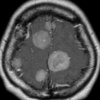 meningiomatosissa1